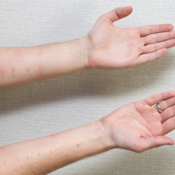 Proven Treatments for Blanching Rashes in Adults