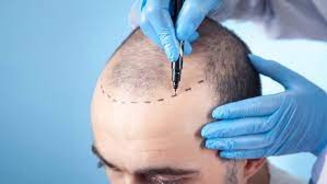  The Remarkable Benefits Of FUE Hair Transplant Treatment