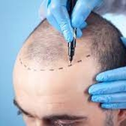  The Remarkable Benefits Of FUE Hair Transplant Treatment