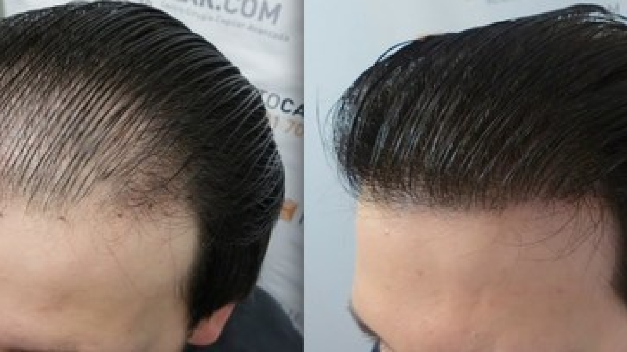 El costo promedio del trasplante de cabello: 5 factores que deciden el precio del procedimiento