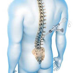 Revolutionising Spine Care: The Game-Changing Benefits of Less Invasive Surgery