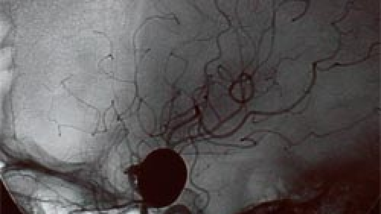 Cerebral Aneurysm Market Size, Industry Analysis And Forecast 2023-2033