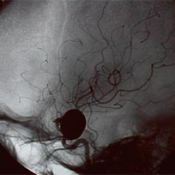 Cerebral Aneurysm Market Size, Industry Analysis And Forecast 2023-2033