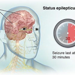 Status Epilepticus Market Size 2023: Epidemiology, Industry Overview, Growth, Trends, Opportunities and Forecast to 2033