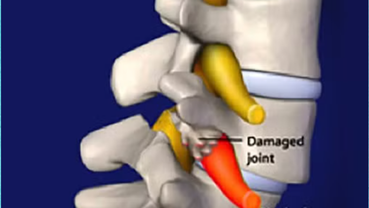 Lumbar Spinal Fusion NJ