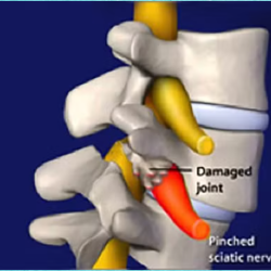 Lumbar Spinal Fusion NJ