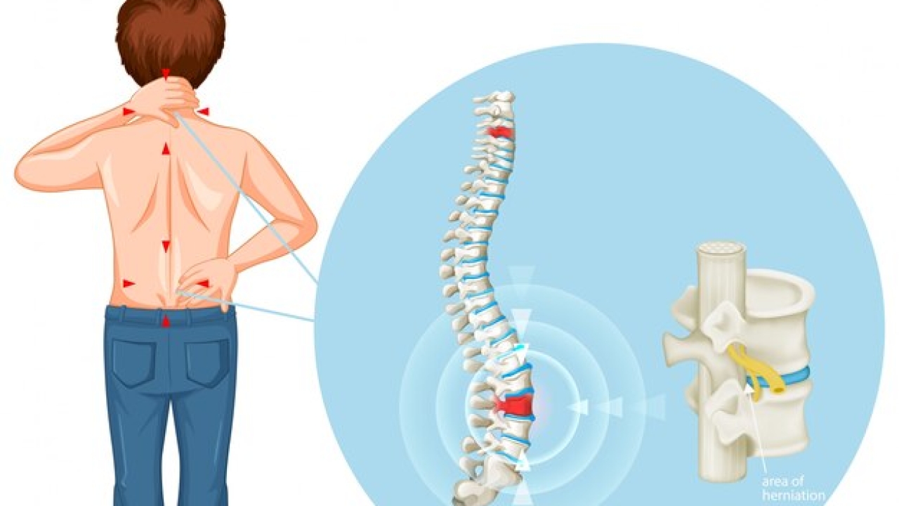 Know About Slipped Disc In Depth: Slipped Disc Treatment in Punjab |Neuro Life Brain & Spine Centre