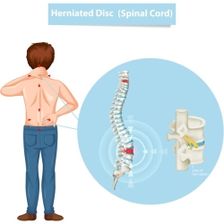 Know About Slipped Disc In Depth: Slipped Disc Treatment in Punjab |Neuro Life Brain & Spine Centre