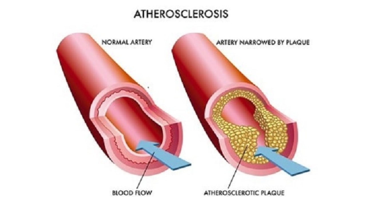 2023, Atherosclerosis Market | Industry Analysis Till 2033