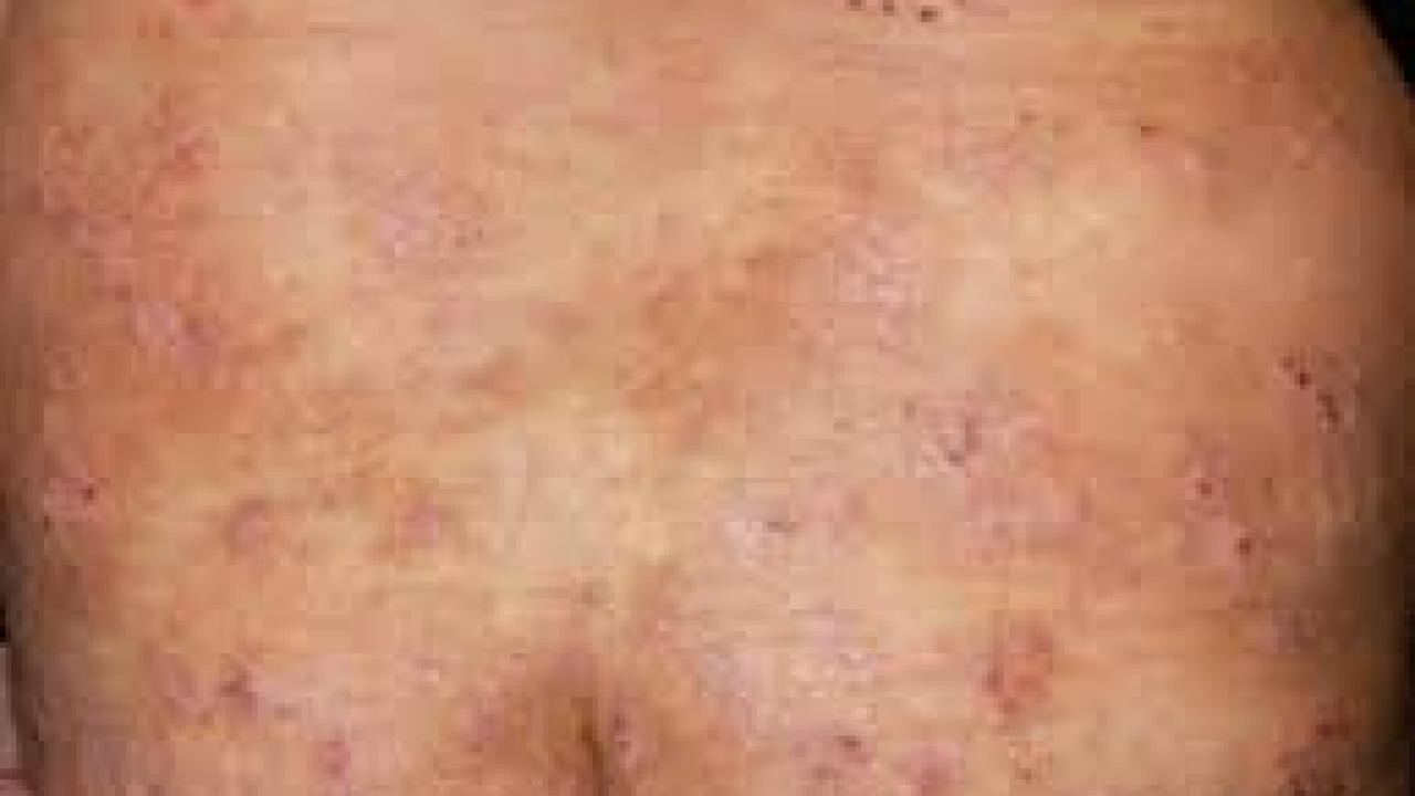 Pruritus Market Size 2023 | Forecast till 2033