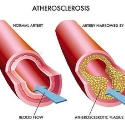 2023, Atherosclerosis Market | Industry Analysis Till 2033