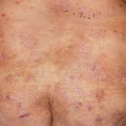 Pruritus Market Size 2023 | Forecast till 2033