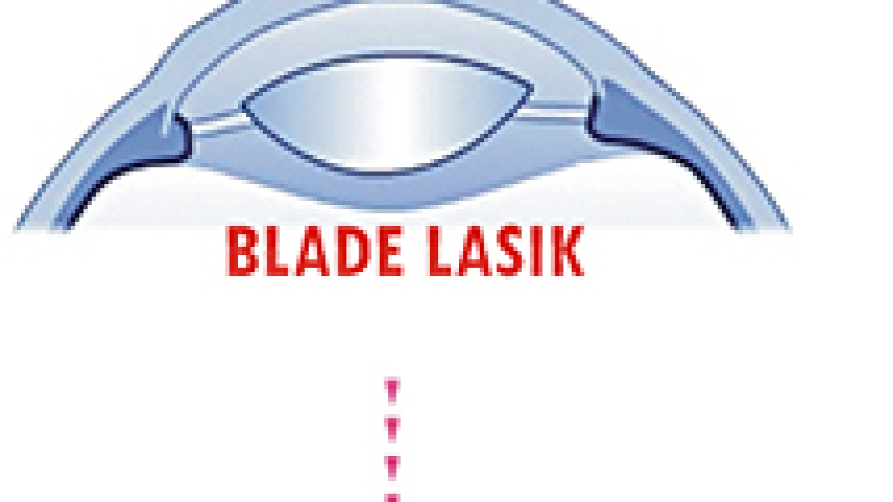 How Blade-Free Lasik Improves Safety and Accuracy