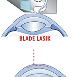 How Blade-Free Lasik Improves Safety and Accuracy