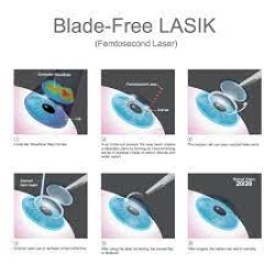 How Blade-Free Lasik Improves Safety and Accuracy