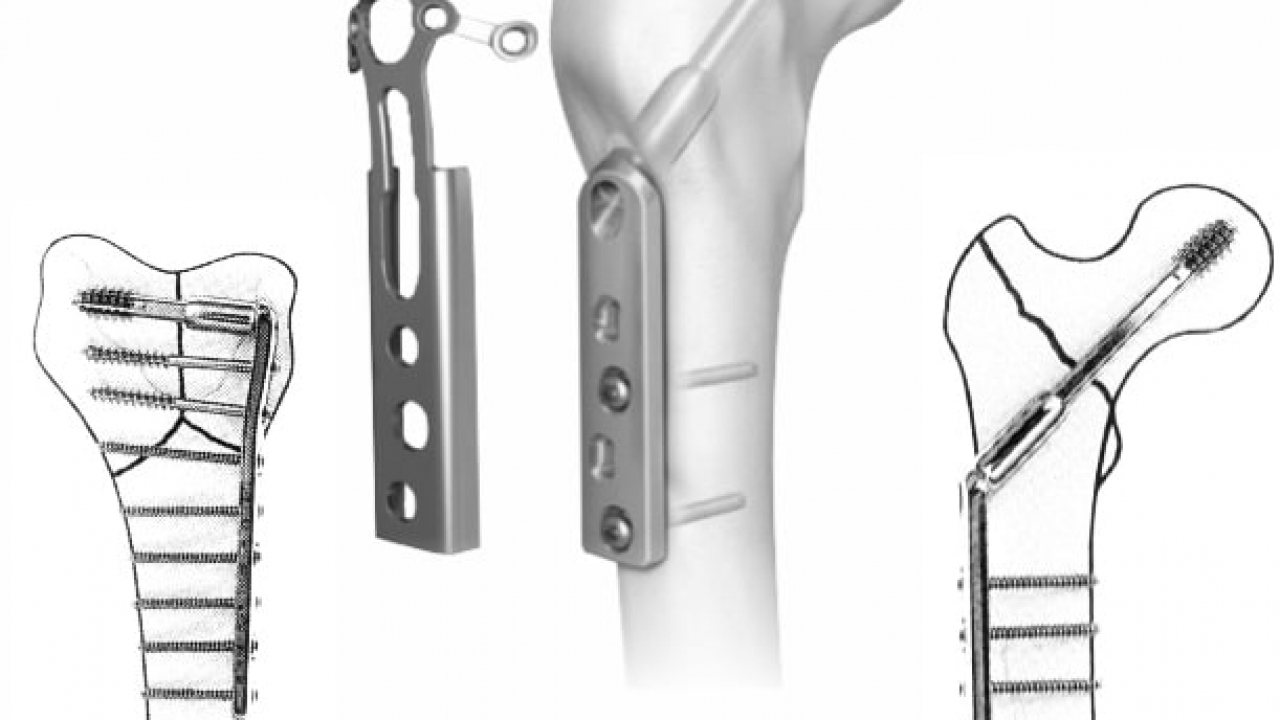 The Best Orthopedic Implants Exporter