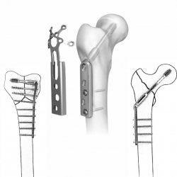 The Best Orthopedic Implants Exporter