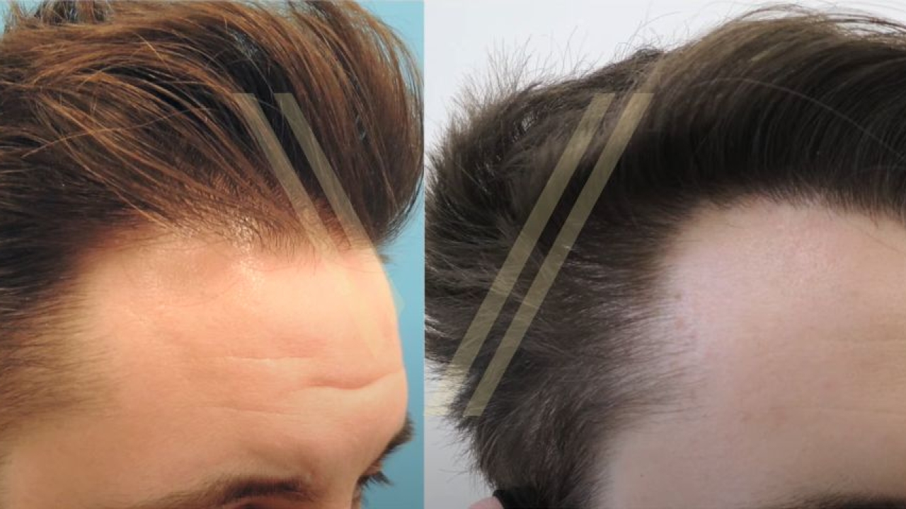 The Complete Guide to Successful Hair Transplants