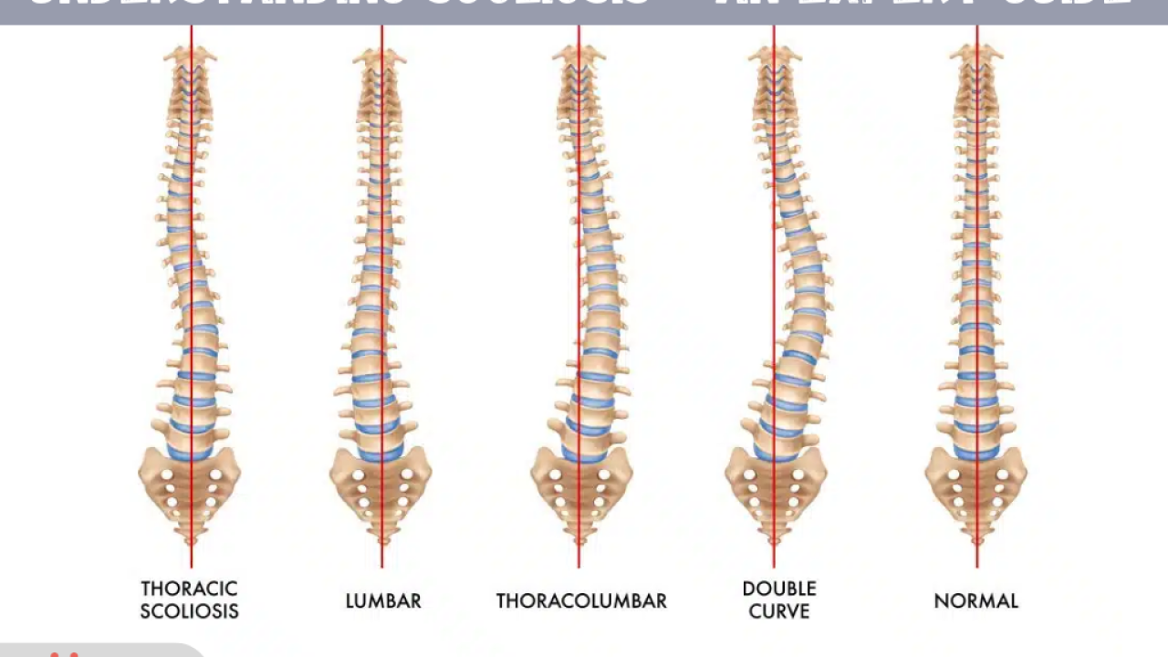 Understanding Scoliosis - An Expert Guide