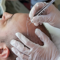 Unleash Your Confidence with the Best Hair Transplant: Hair Transplant in Vizag | Dr. VJs Cosmetic Surgery Hair Transplant